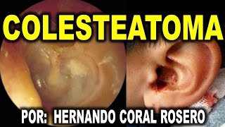 COLESTEATOMA  QUISTE DE OIDO MEDIO O HUESO CRANEAL MASTOIDEO [upl. by Dosi]