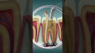 Root Canal Treatment  Curveia Dental I RCT [upl. by Burtie]