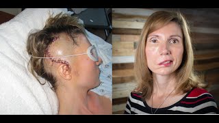 Brain Tumor Journey 2 From dizzy spells headaches vertigo to diagnosis Jodi Orgill Brown [upl. by Kassie444]