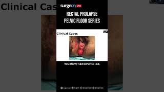 First Episode of the Pelvic Floor Series Rectal Prolapse [upl. by Brucie825]