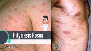 What is Pityriasis Rosea [upl. by Aerdnaz323]