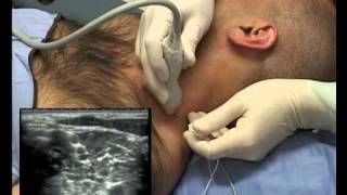 Interscalene Block ultrasound guided  in plane [upl. by Ahoufe]