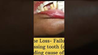 Watch Live Incredible Missing Teeth Treatment Journey missingteeth shorts permanentteeth [upl. by Apps]