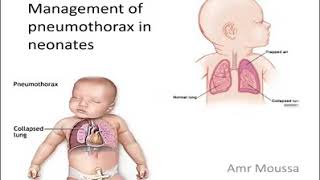 Management of pneumothorax in newborn Dr Amr Moussa Evidence based 2020 [upl. by Miguel]