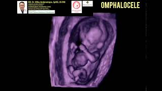 Omphalocele [upl. by Assed743]