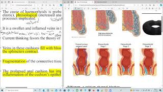 Haemorrhoids Clinical Pharmacy [upl. by Agata]