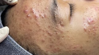 ACNE TREATMENT VU QUYNH MI  Perennial Blackheads On Boy Face 2024FULL [upl. by Staffan169]