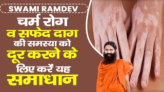 चर्म रोग Skin Disease व सफेद दाग की समस्या को दूर करने के लिए करें यह समाधान  Swami Ramdev [upl. by Attey]