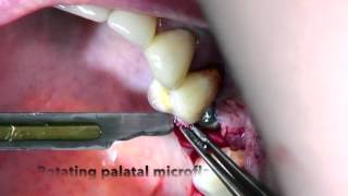 Flap closure after GBR in posterior maxilla [upl. by Timms]