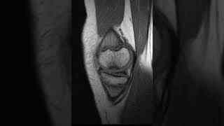 Osteochondritis dissecans of the knee [upl. by Whitcher652]