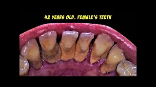 How Teeth Are Cleaned At The Dentist  TARTAR  Dentist  Dokter Gigi Tri Putra [upl. by Imak50]