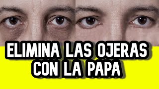 COMO QUITAR LAS OJERAS DE LOS OJOS CON PAPA [upl. by Olwena521]