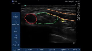 Suprascapular nerve Proximal sonographic anatomy subomohyoid block technique [upl. by Hairym]