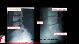 What is Spondylosis Osteoarthritis Spinal degeneration [upl. by Atiuqihc]