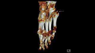 5th metatarsal base fracture [upl. by New]