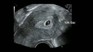 Ultrasound 5 Weeks Gestation Early pregnancy scan [upl. by Lindsey]