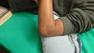 Elbow stiffness exercise [upl. by Abott201]