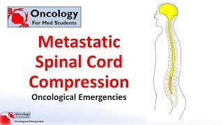 Metastatic spinal cord compression [upl. by Lorak]