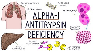 Understanding Alpha1 Antitrypsin Deficiency [upl. by Ahsinauq]