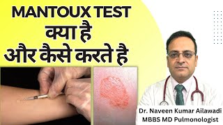 Mantoux Test क्या है और कैसे करते है  Mantoux tuberculin skin test TST TB Test  Diagnosis of TB [upl. by Eiramllij]