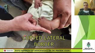 Congenital Talipes Equino Varus  Clinical Orthopaedics  Dr Prateek Joshi M S  MEDUSANE [upl. by Thalia]