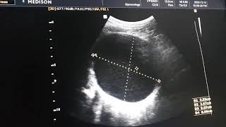 Bilateral Adnexal cystic Masses [upl. by Asli887]