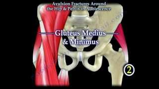 Avulsion Fractures Around The Hip In Adolescence  Everything You Need To Know  Dr Nabil Ebraheim [upl. by Lusa]