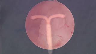 Hysteroscopic Polypectomy and Removal of Embedded Intrauterine Device IUD [upl. by Milan]