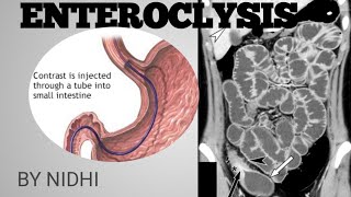 ENTEROCLYSIS PROCEDURE IN HINDI  ENTEROCLYSIS [upl. by Harriman111]