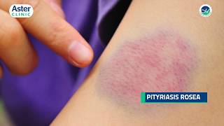 Dr Srinivasa Munivenkatappa talks about Pityriasis Rosea [upl. by Naloj384]