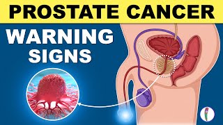 Prostate Cancer Signs  Warning Signs of Prostate Cancer [upl. by Enidlarej]