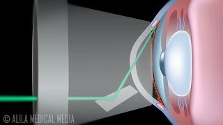 Laser Trabeculoplasty for Glaucoma ALT vs SLT Animation [upl. by Sari]