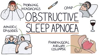 Obstructive Sleep Apnoea [upl. by Oilasor]