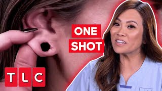 Dr Lee Only Has ONE SHOT To Repair A Woman’s Earlobes  Dr Pimple Popper This Is Zit [upl. by Atnas]