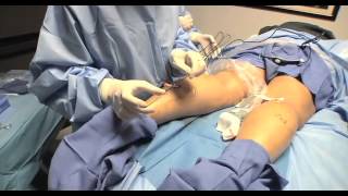 Varicose Vein Ablation  UCLA Vital Signs [upl. by Sorcim]