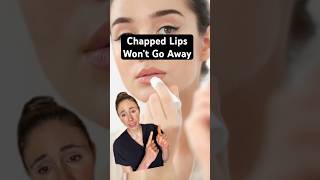 Dry Cracked Lips That Dont Heal dermatologist [upl. by Retsel]