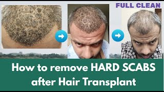 How to remove Hard Scabs after Hair Transplant  KV Hair Care amp Life [upl. by Tnahs]