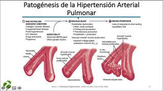 Fisiopatología de la Hipertensión Pulmonar [upl. by Ribak]