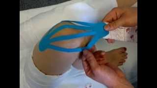 Kinesio tape felhelyezése térdre  kinesiotaping [upl. by Hael]