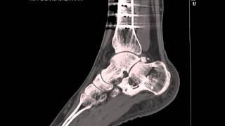 CT scan of ankle [upl. by Orva]