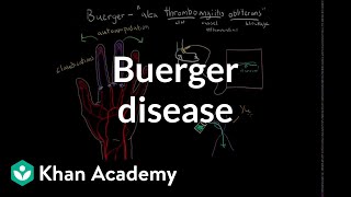 Buerger disease  Circulatory System and Disease  NCLEXRN  Khan Academy [upl. by Harias]