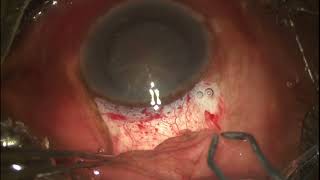 OneMinuteOphthalmology  Effective Use of Cautery in SICS SurgicalSaturday [upl. by Eelarbed]