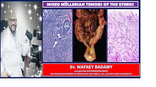 MIXED MÜLLERIAN TUMORS OF THE UTERUS BY Dr WAFAEY BADAWY [upl. by Ivonne]