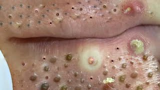 Big Cystic Acne Blackheads Extraction Blackheads amp Milia Whiteheads Removal Pimple Popping  703 [upl. by Latreshia590]