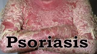 Home Remedies For Psoriasis  How To Treat Psoriasis Naturally [upl. by Anidan578]