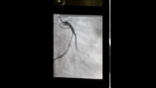 Prosthetic mitral valve and stent in left circumflex artery [upl. by Cramer129]