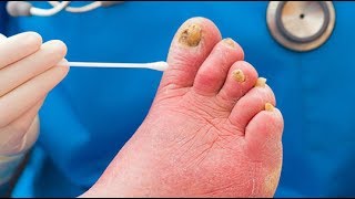 Best Toenail Fungus Treatment 1 Secret Remedy At The End of This Video [upl. by Yekram]