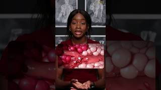 Sickle Cell Anaemia Explained and Simplified [upl. by Sices138]