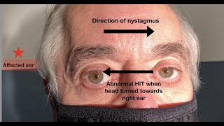 What ear does the nystagmus in vestibular neuritis beat towards [upl. by Atsocal295]