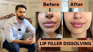 Dissolving Lip Filler  Amazing Results [upl. by Janifer]